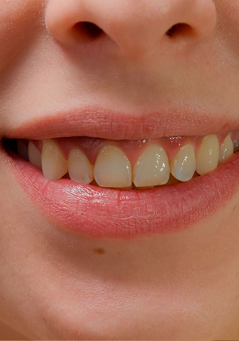 Cierre de sonrisa gingival mediante cirugia periodontal y ortodoncia