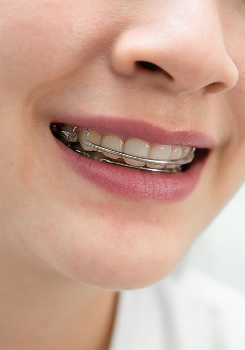 Correccion de apinamiento y cierre de diastema en paciente joven