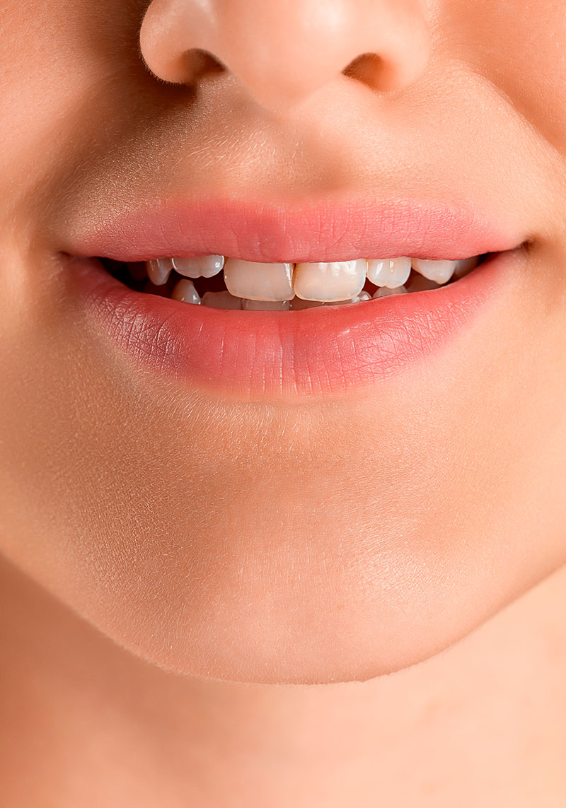 Incrustaciones de ceramica para recuperar molares posteriores