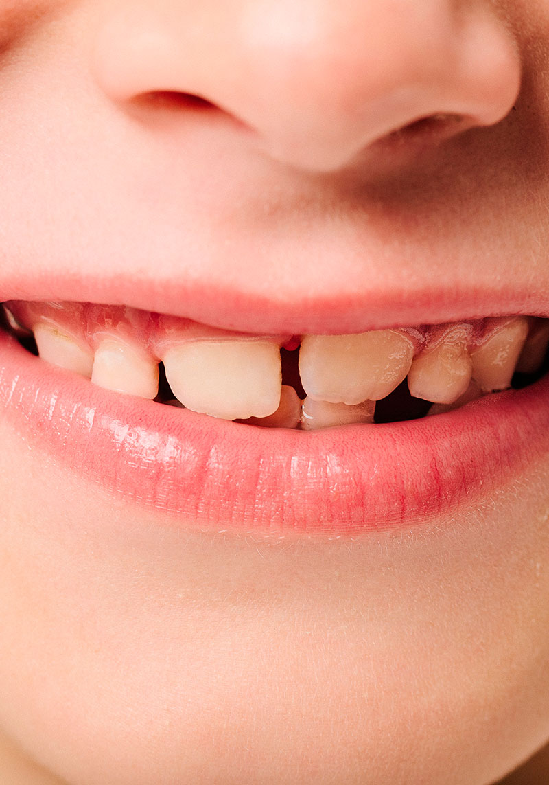 Rehabilitacion compleja con protesis fija sobre implantes