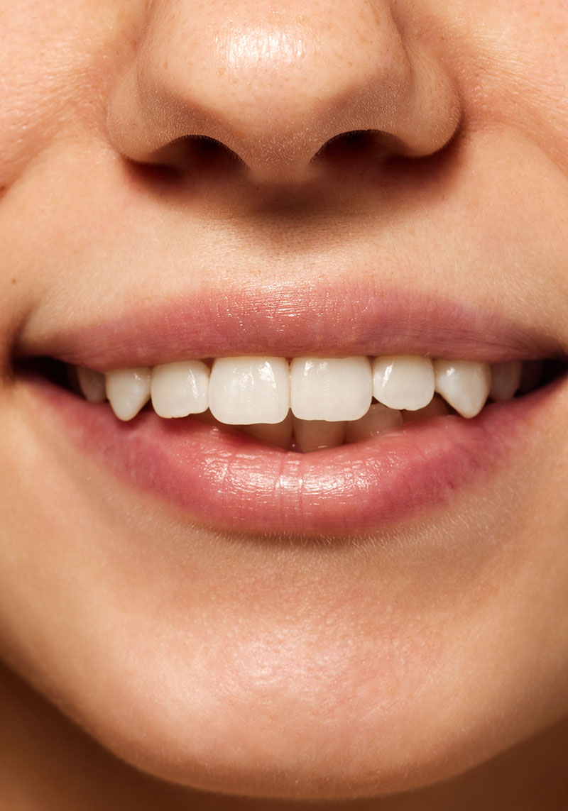 Rehabilitacion con implantes unitarios en sector anterior